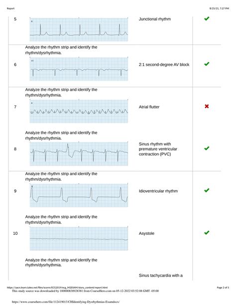 dysrhythmias. What are the clinical manifestations of dysrhythmias? chest pain, decreased level of consciousness. shortness of breath. What position do you put the Pt. for a 12 lead ECG. supine. What do you instruct the Pt. to do during a 12 lead ECG. lie still and breath normally through the nose.